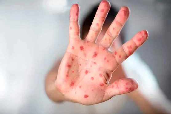 کراچی: بچوں میں خسرہ کے مریضوں میں اضافہ، اسپتالوں میں صورتحال تشویشناک